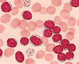 Acute Basophilic Leukemia Cells (ABLC)
