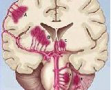 Cerebral Hemorrhage (CH)
