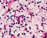 Renal Cell Carcinoma Cells (RCCC)