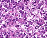 Hepatoblastoma Cells (HB)