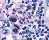Non-Small Cell Lung Carcinoma Cells (LCLC)