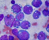 Burkitt's Lymphoma Cells (BLC)