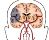 Focal Cerebral Ischemia (FCI)