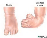 Club Foot (CF)