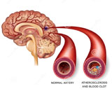 Cerebral Atherosclerosis (CAS)