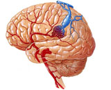 Cerebral Arteriovenous Malformation (CAVM)
