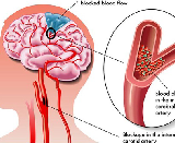 Cerebral Ischemia (CI)