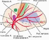 Cerebral Lacunar Infarction (CLI)