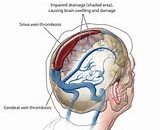 Cerebral Thrombosis (CT)