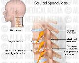 Cervical Spondylosis (CS)