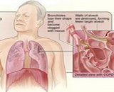 Chronic Bronchitis (CB)