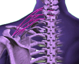 Spinal Nerve Roots Compressive Injury (SNRCI)