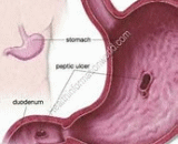 Chronic Gastric Ulce (CGU)