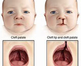Cleft Lip and Palate (CLP)