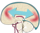 Closed Mechanical Brain Injury (CMBI)