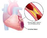 Coronary Artery Convulsion (CAC)