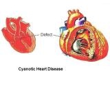 Cyanotic Heart Disease (CHD)