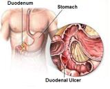 Duodenal Ulcer (DU)