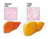 Fatty Liver (FL)