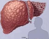 Liver Cirrhosis (LC)