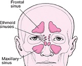 Maxillary Sinusitis (MS)