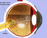 Ocular Ischemic Syndrome (OIS)