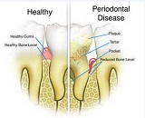 Periapical periodontitis (PP)