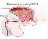 Prostatic Hyperplasia (PH)