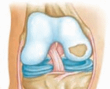 Articular Cartilage Injury (ACI)