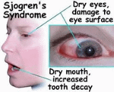 Sjogren Syndrome (SS)