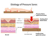 Skin Pressure Ulcer (SKU)