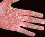 Staphylococcal Scalded Skin Syndrome (SSSS)