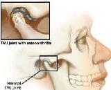Temporomandibular Osteoarthrosis (TO)