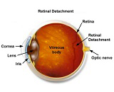 Tractional Retinal Detachment (TRD)