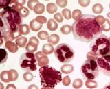 Acute Promyelocytic Leukemia Cells (APLC)
