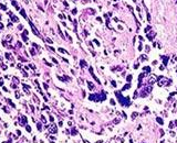 Pleural Mesothelioma Cells (PMC)