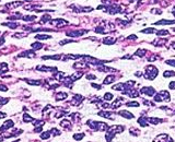 Ewing's Sarcoma Cells (EWSC)