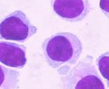 Umbilical Cord Blood Mononuclear Cells (UCBMC)