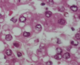 Adenoid Cystic Carcinoma Cells (ACCC)