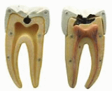 Dental Caries (DC)