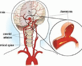 Hypertensive Cerebral Arteriosclerosis Stroke (HCAS)