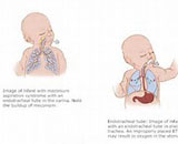 Meconium Aspiration Syndrome (MAS)