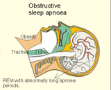 Obstructive Sleep Apnea Hypopnea Syndrome (OSAHS)